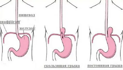 Csúszó hiatus hernia tünetek és a kezelés