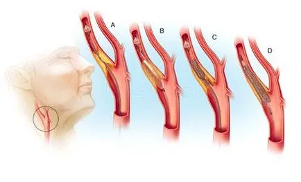 Каротидна артерия стент или стент каротидна - medglobus medglobus