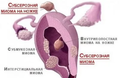 Подсерозни миома на матката какво е лечението подсерозни сайт