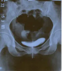 Fistula vezicii urinare, urolog meu
