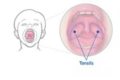Тонзилит - лечение, симптоми, причини