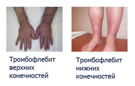 Thrombophlebitis - típusok, poszt-traumás, akár az alkoholfogyasztás, a dohányzás, a stressz, a beteg,