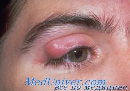 Туберкулоза на окото - клиника, диагностика