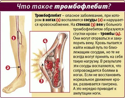 Tromboflebita - tipuri, post-traumatic, dacă consumul de alcool, fumatul, stresul, bolnav,