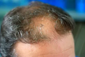 Hogyan kell kezelni alopecia gyermekeknél