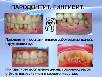 Видове зъбни патологии и контролни антибиотици с заболяване на венците и кариес и народната