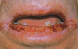 Cheilitis - okai, tünetei, diagnózisa és kezelése