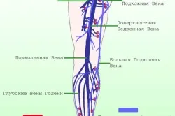 Хронична венозна недостатъчност на долните крайници, лекувани