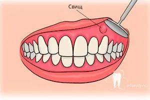 fistula dentara dupa indepartarea arata ca, tratamentul la domiciliu