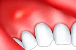fistula dentara dupa indepartarea arata ca, tratamentul la domiciliu