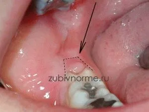 Care este simptome pericoronitis, tratament, fotografii