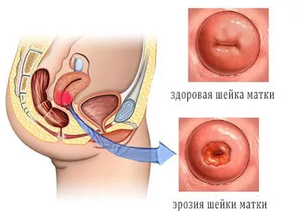 Какво е на шийката на матката ерозия след от изгаряне на снимки и видеоклипове