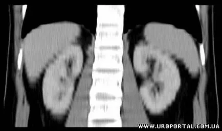 Tomografie computerizata in urologie