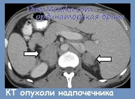 Adrenal komputertomográfia - jelei tumor