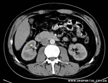 Tomografie computerizata in urologie