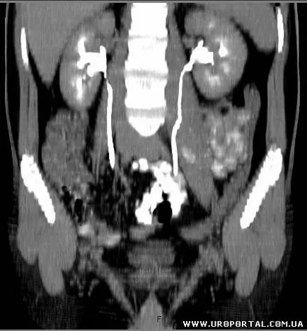 Tomografie computerizata in urologie