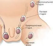 Крипторхизъм - лечение