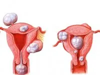 Tratamentul fibrom uterin, metode moderne și eficiente