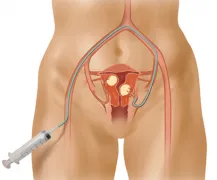 Tratamentul fibrom uterin, metode moderne și eficiente