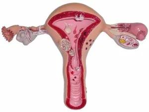 Tratamentul și prevenirea fibrom uterin remedii populare - cauze, simptome