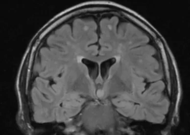 tratamentul epilepsiei, în Germania