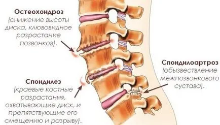 Fizioterápiás nyaki osteochondrosis leírás, videó