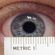 simptome Megalocornea, diagnostic și tratament