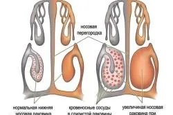 Възможно ли е с хрема в баня