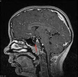 MRI мозъка турски седло, където синдрома на празния Sella