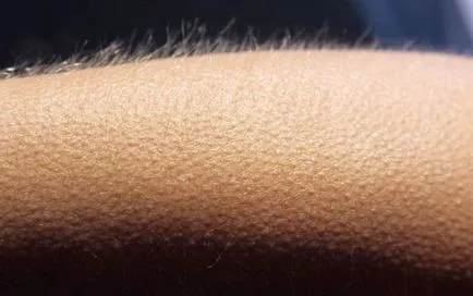 Goosebumps erős érzelem, vagy tünete a súlyos betegség