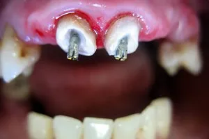 Kapacitás a fogak előtt és után, előnyeiről és hátrányairól helyreállítás, videó
