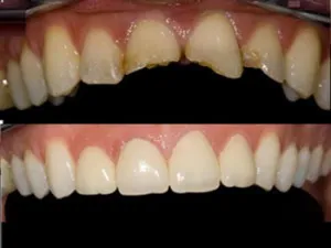 Kapacitás a fogak előtt és után, előnyeiről és hátrányairól helyreállítás, videó
