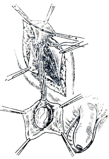 Aducerea în jos testiculul în scrot cu conservarea pediculului testiculare 1989 și Kirpatovsky