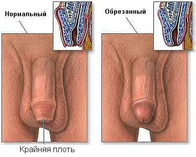 Обрязването в Америка