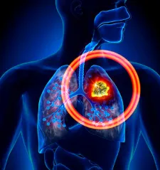 Pancoast tumor tünetek és a kezelés a tüdőrák szindróma Pancoast