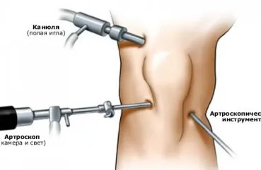 Műtét a térd meniscus, típusai és rehabilitációs