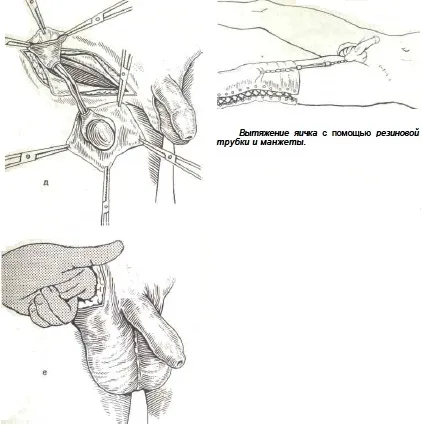 Orchidopexy (testicul retrogradare)