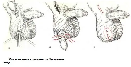 Orchidopexy (testicul retrogradare)