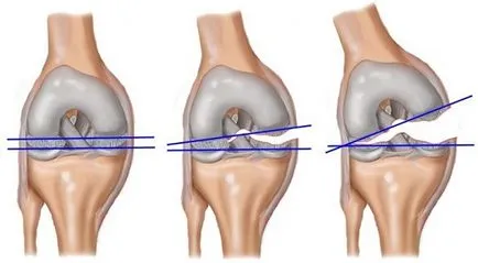 Műtét a térd meniscus, típusai és rehabilitációs