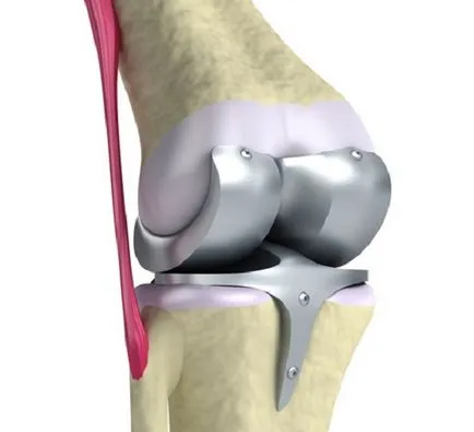 Műtét a térd meniscus, típusai és rehabilitációs