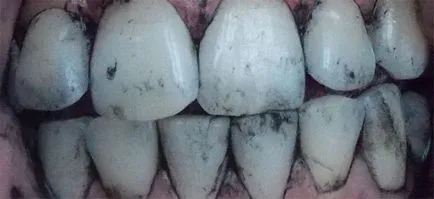 избелване на зъбите активен въглен - прост и ефективен