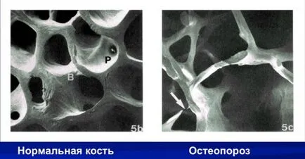 Osteoporoza în raze X cum să identifice semnele radiologice