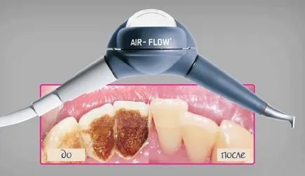 Избелване на зъби достойнство на въздушния поток, същността на метода и ползите