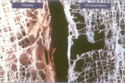 Osteoporoza în raze X cum să identifice semnele radiologice