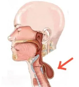 Zenker diverticulum tünetek, kezelés, leírás