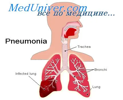 Diagnosticul de inflamație bacteriană în pneumologie