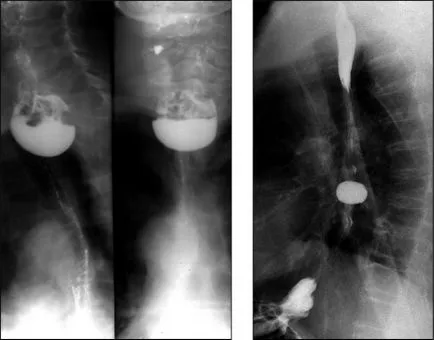 nyelőcső diverticulum, Zenker, pulsionny, tapadás - tünetek, kezelés, sebészi eltávolítása,