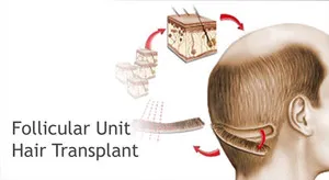 Indicații de transplant de par pentru această procedură, metodele de bază și a prețurilor la Moscova