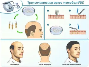 Indicații de transplant de par pentru această procedură, metodele de bază și a prețurilor la Moscova