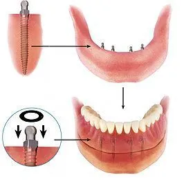 proteze laminar de fabricare de proteze plăci amovibile, laminar dentare